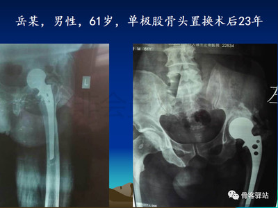 天津股骨头置换费用多少费用多少费用多少