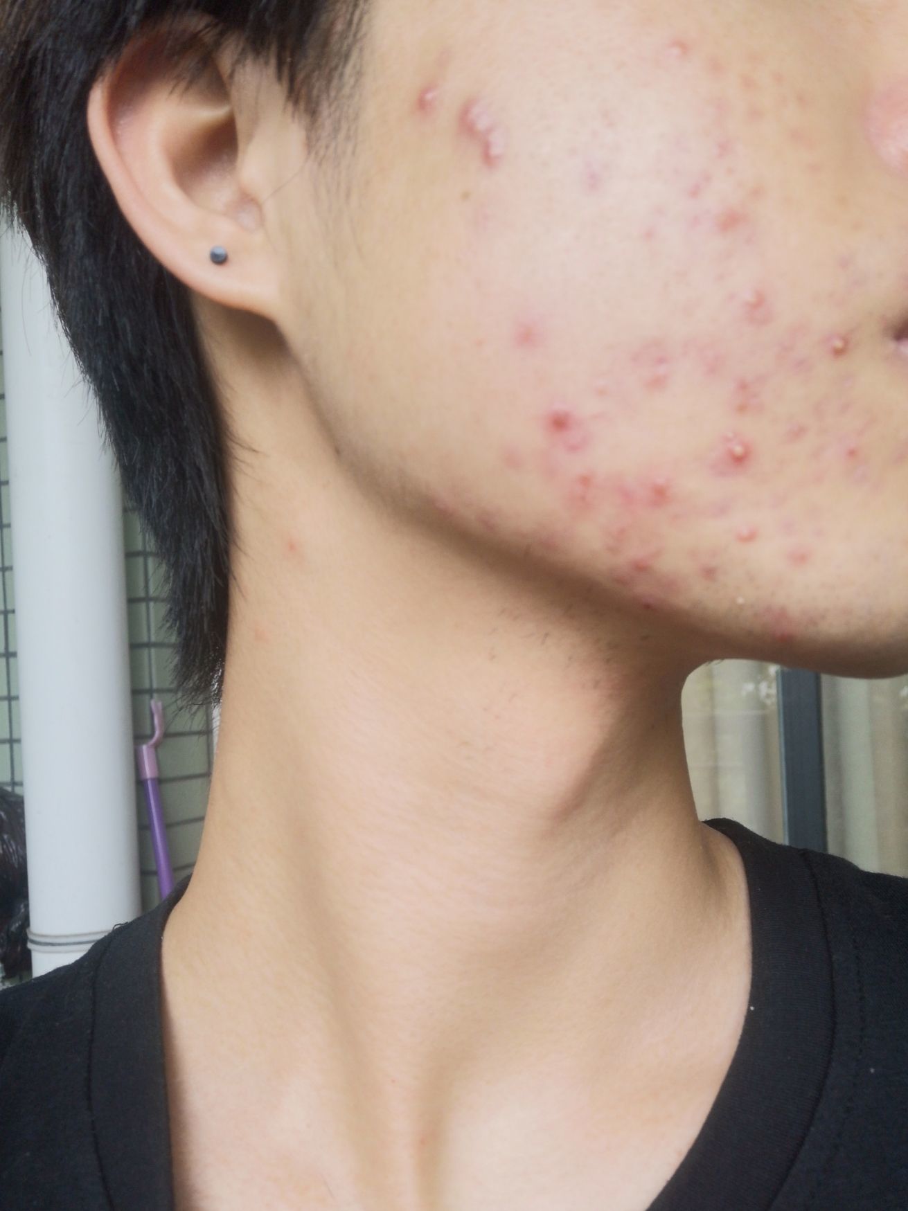 长痘痘的四个阶段