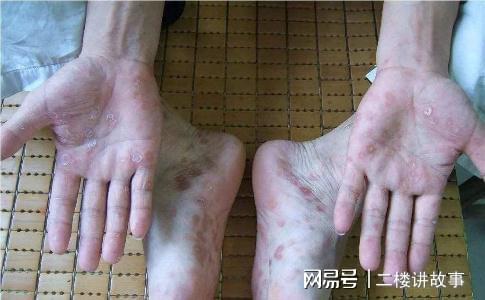 手脚潮湿是怎么回事