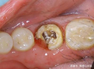 牙齿发炎怎么治疗