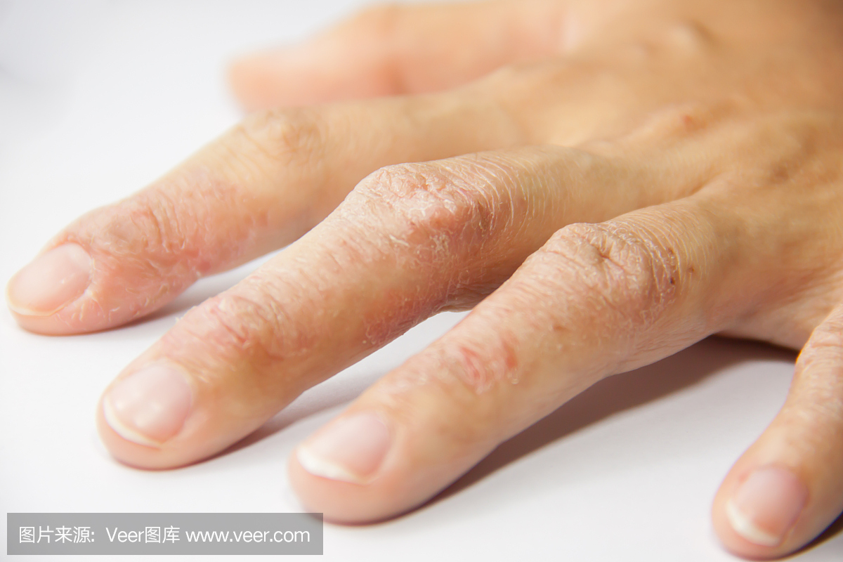 拍手掌可以治痘痘吗