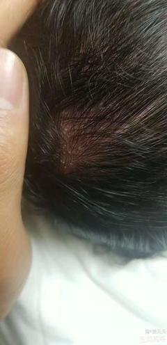 头顶出痘痘是什么原因