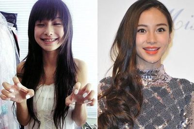 牙套会改变脸型吗