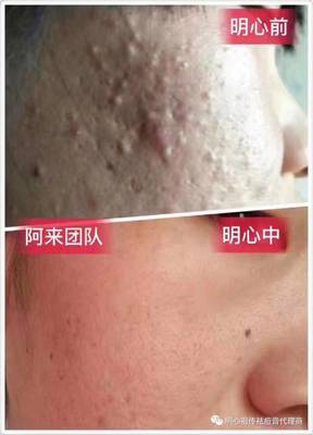 美容院能治好痘痘吗