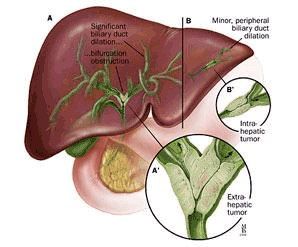 胆管癌