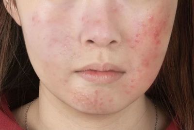 痘痘黑印子是什么