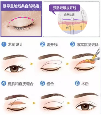 单眼皮埋线疼吗