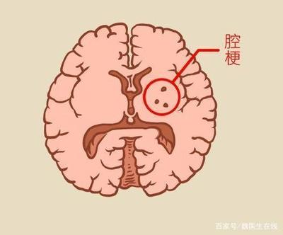 脑内小缺血灶怎么治疗
