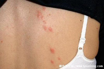 后背全身起痘痘是怎么回事