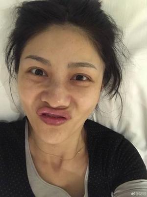 小女生脸上长痘痘怎么去除