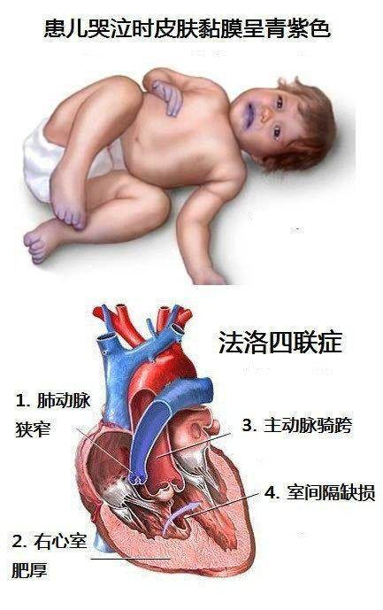 新生儿室间隔缺损