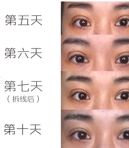 双眼皮忌口多久