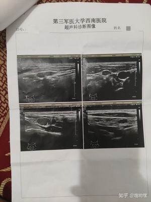 甲状腺碘扫多少钱