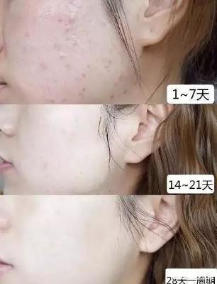 痘痘有周期吗