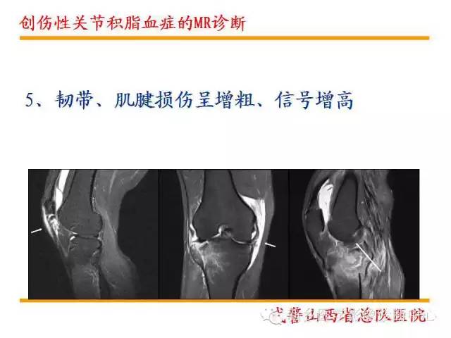 腱鞘积液是怎么回事