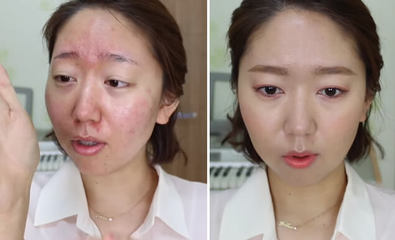 痘痘泛红是怎麽回事