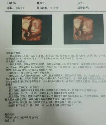侧脑室宽说明胎儿聪明
