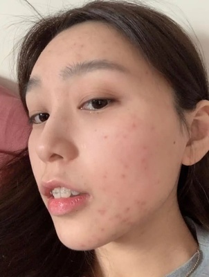 好多痘痘烦死了