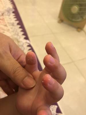 小孩手蜕皮是怎么回事