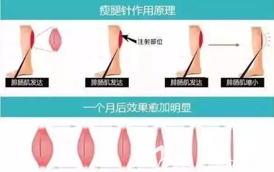 华美瘦腿针要多少钱