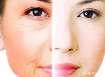 鱼尾纹除皱方法