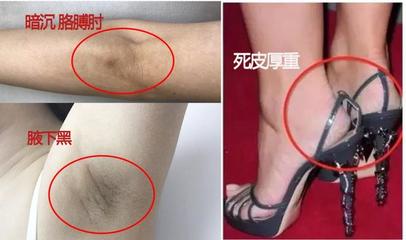 后背长痘痘擦什么