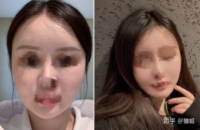 哪抽脂比较好