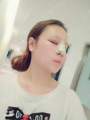广西眼部整形