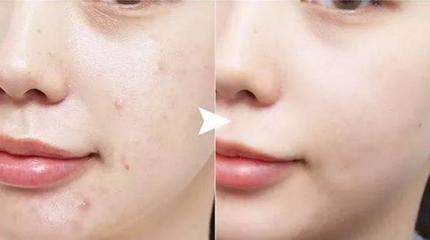 脸上雀斑痘痘怎么护肤