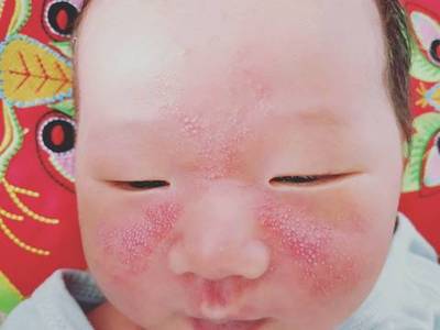红奶白色痘痘