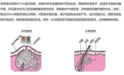 蓝光祛痘原理