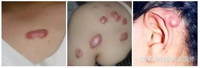 怎样能治好痘痘