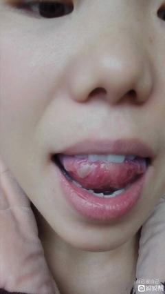 舌头右侧疼是怎么回事