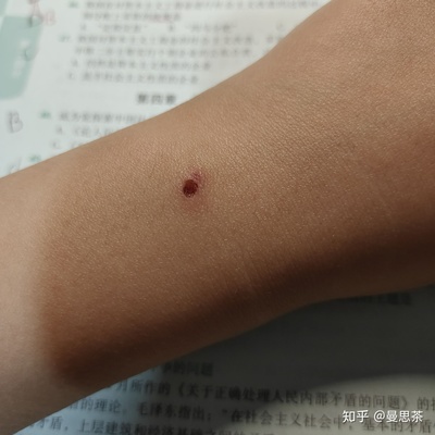 点痣的坑会长平吗