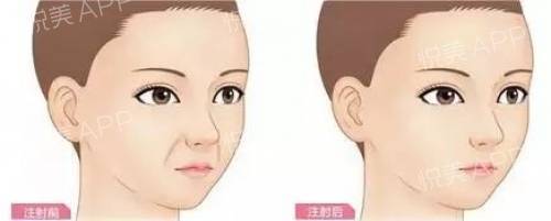 为什么玻尿酸4年不吸收