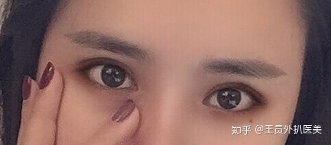 双眼皮割的太窄了