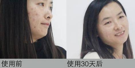 没痘痘可以不用洗面奶吗