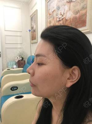 哪里自体隆鼻效果好