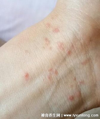 后背全身起痘痘是怎么回事