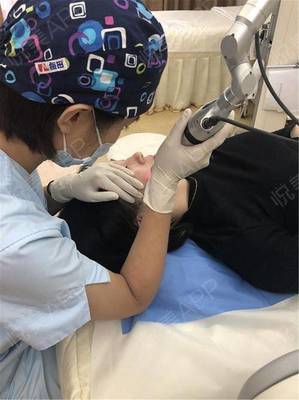 皮秒祛斑后脸上长痘