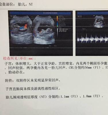 nt检查胎儿心跳多少正常