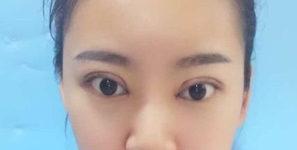 双眼皮不明显咋办