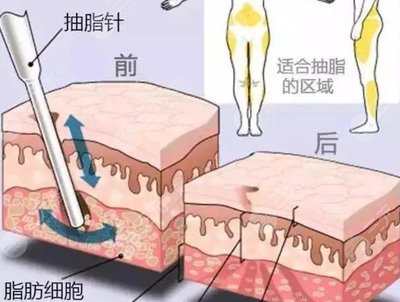 抽脂融脂