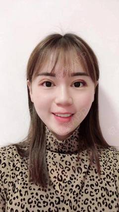 开眼角拆线后多久化妆