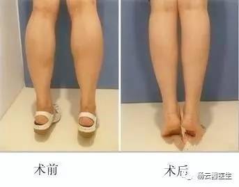 吸脂瘦腿效果如何