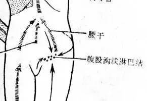 腹股沟淋巴结怎么治疗