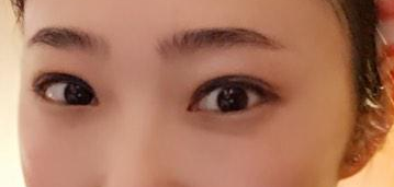 美莱做的双眼皮好吗