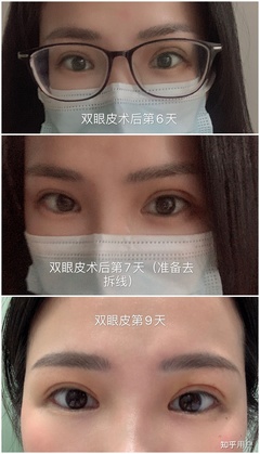 做双眼皮大概费用