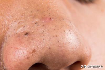 鼻头鼻头有红色的痘痘