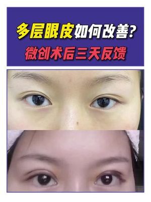 多层眼皮变双眼皮